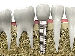 Dental implants - Phipps Dental